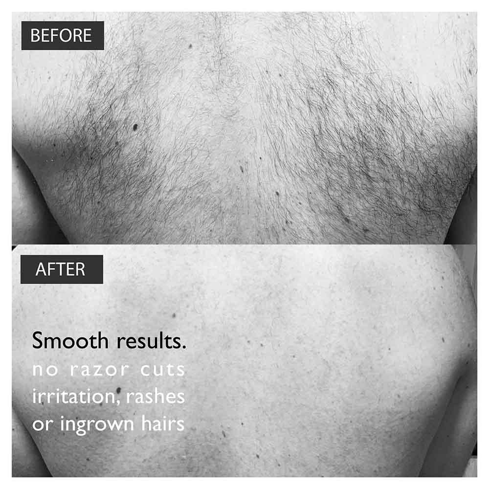 Baldape Parlour – The Silverback Kit (Back & Body Hair Removal System)